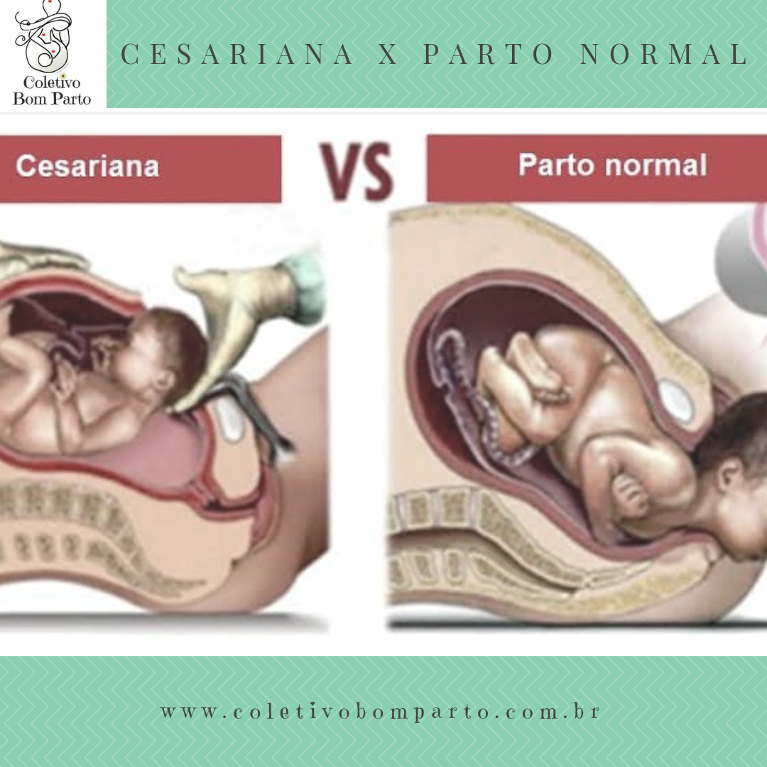 Cesariana ou parto normal? A escolha pode interferir até mesmo no